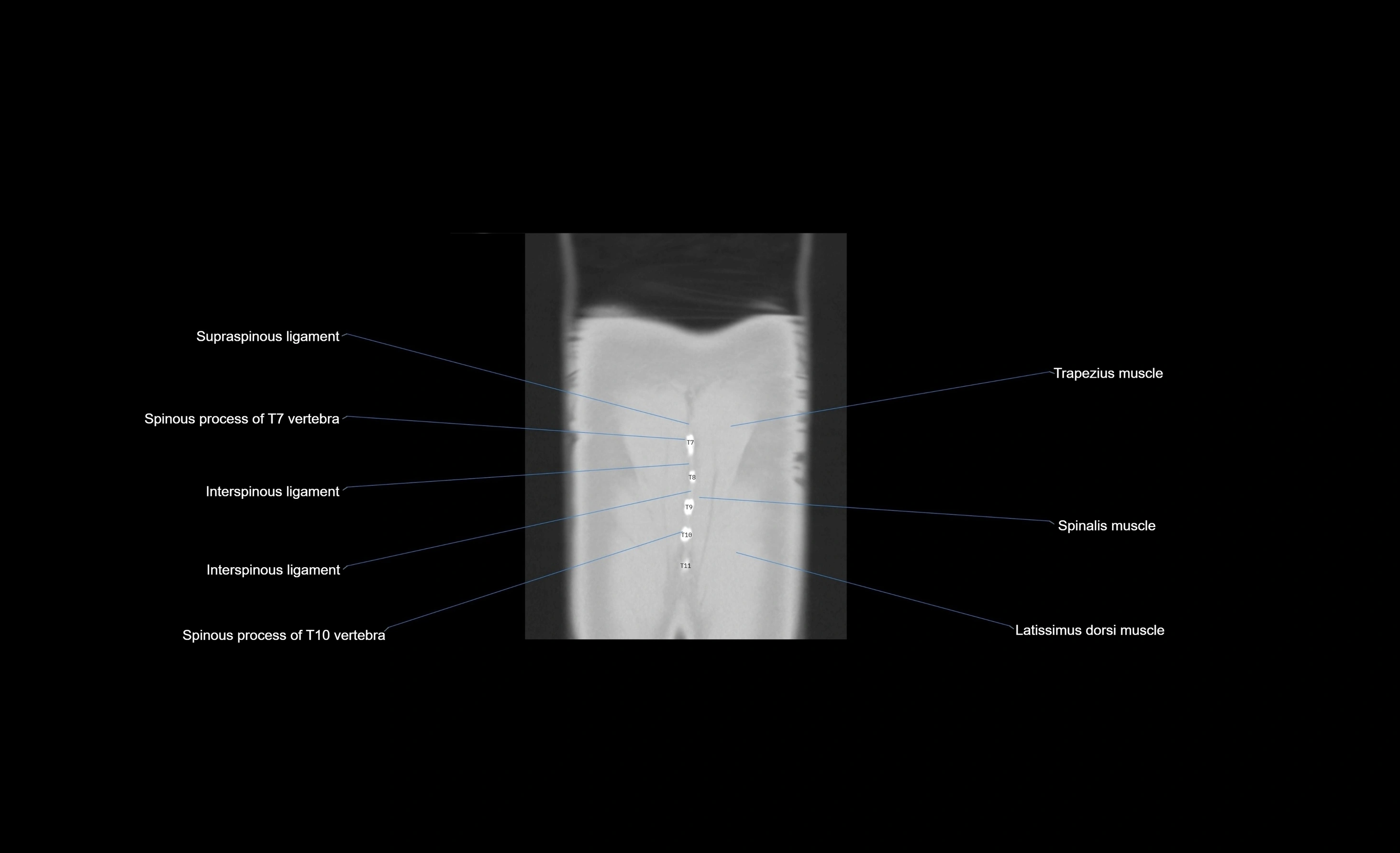 CT chest (thorax) lung window window labelled coronal cross sectional anatomy radiology image-00006.webp